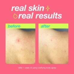 Dermalogica Clear Start Clarifying Bacne Body Spray For Acne-Prone Body Skin 177ml -Outlet Soft Touch Care Store clear start clarifying bacne body spray for acne prone body skin 177ml p33599 96287 image