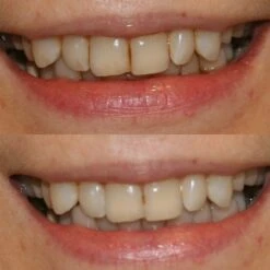 Professional Teeth Whitening Kit -Outlet Soft Touch Care Store professional teeth whitening kit p17007 42558 image